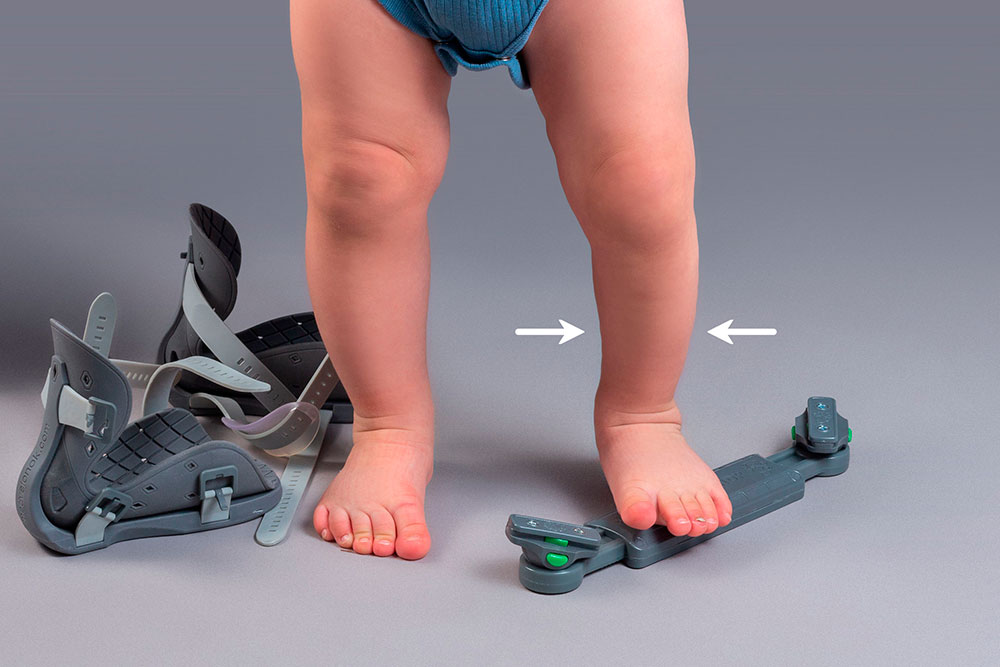 Почему голень на ножке с косолапостью становится заметно худее? 