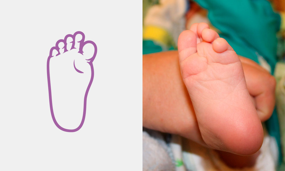 Выраженное подошвенное сгибание первой плюсневой кости