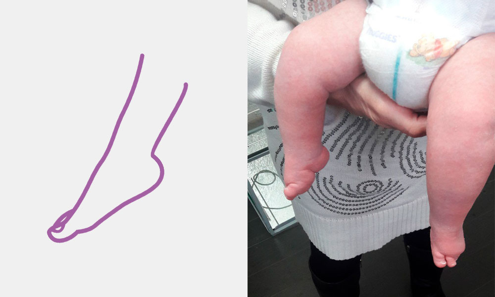 Эквинусная стопа при косолапости