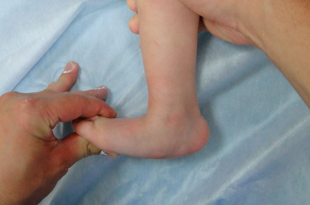 Аномалия развития стопы - вертикальный таран