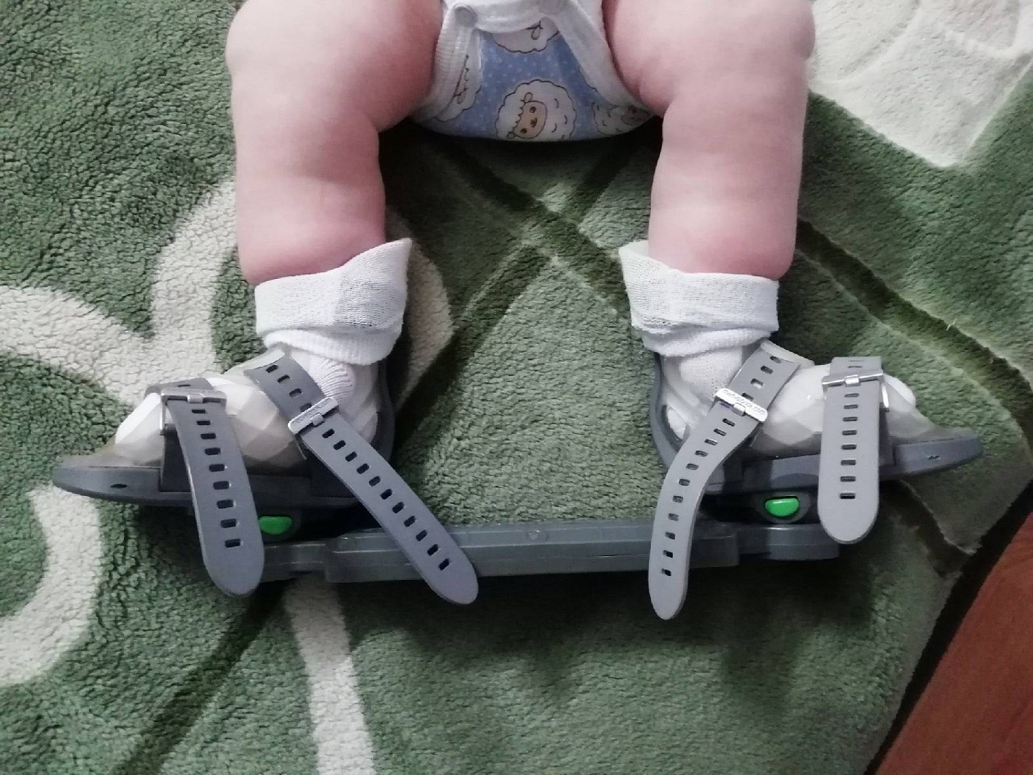 Брейсы Понсети